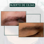 injerto de cejas con técnica FUE todo lo que tienes que saber en el blog de la Dra Ximena Vila - Madrid