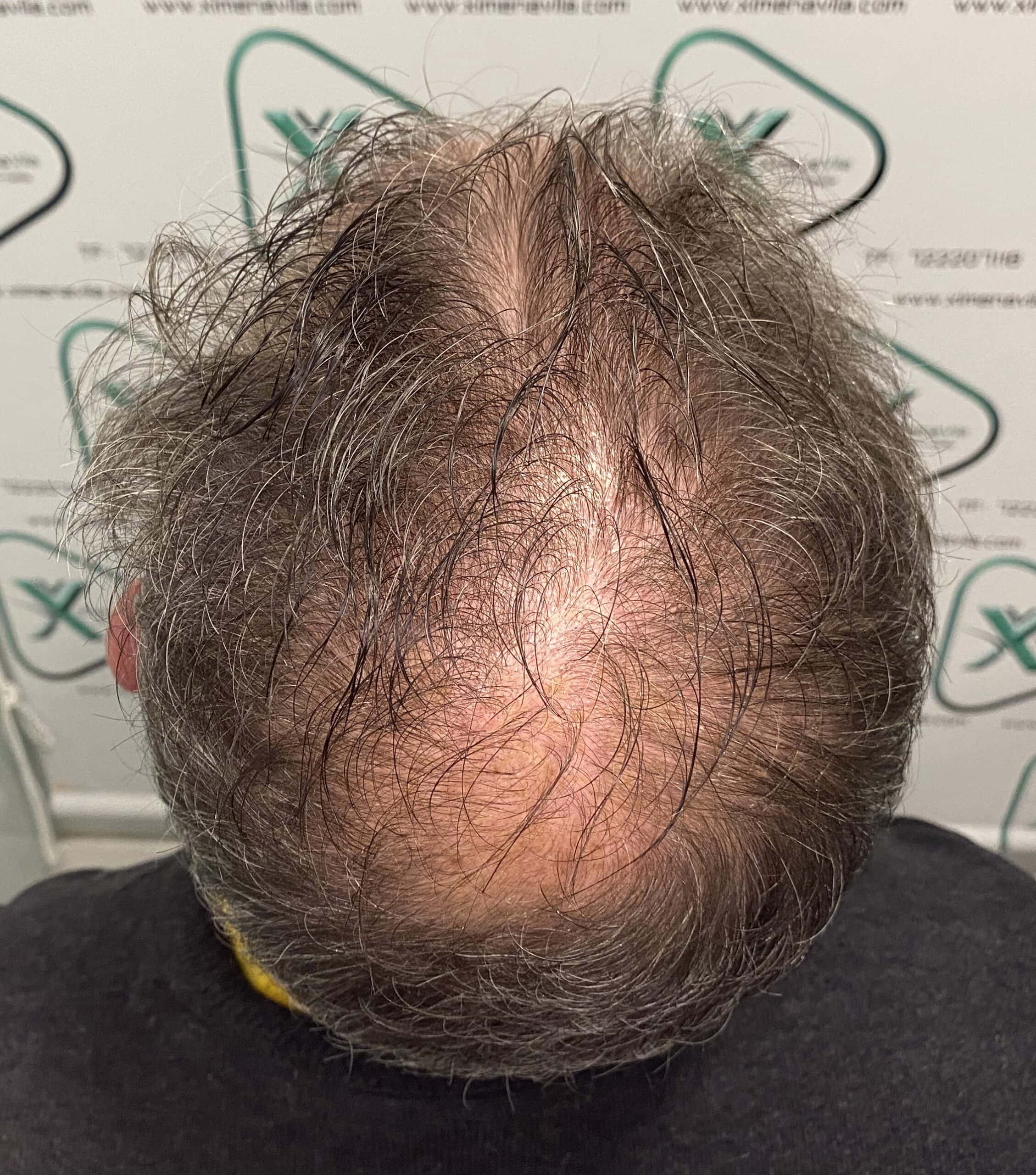 Dutasteride y Minoxidil: ¿funcionan mejor juntos?-3