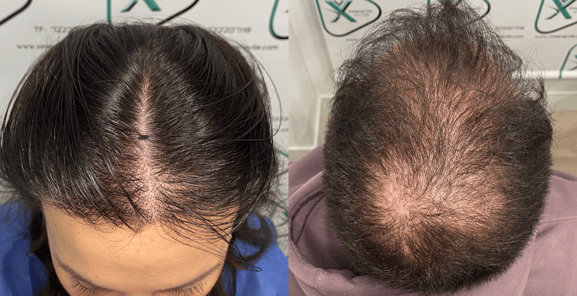 Alopecia androgénica_ qué es y tratamientos más efectivos (3)